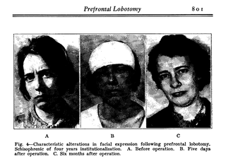 Illustration for article titled The strange, sad history of the lobotomy